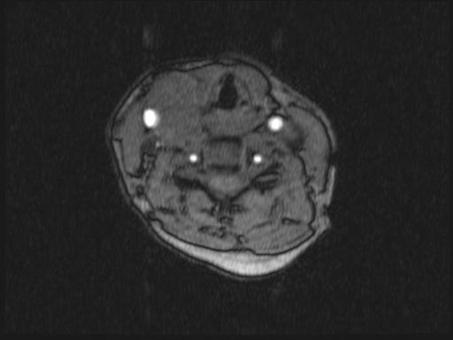 Bilateral carotid body tumors and right glomus jugulare tumor (Radiopaedia 20024-20060 Axial MRA 238).jpg