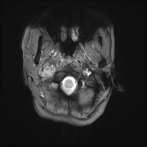 File:Bilateral carotid body tumors and right jugular paraganglioma (Radiopaedia 20024-20060 Axial 73).jpg