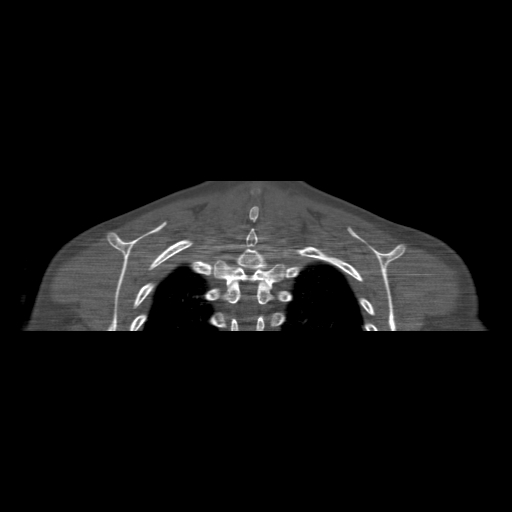 File:Bilateral chronic posterior shoulder dislocation (Radiopaedia 39213-41452 Coronal bone window 52).jpg