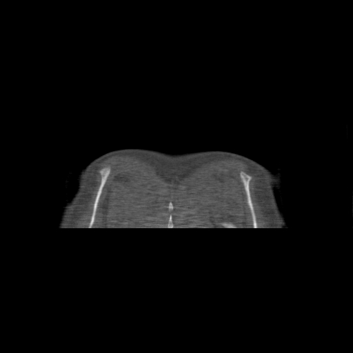 File:Bilateral chronic posterior shoulder dislocation (Radiopaedia 39213-41452 Coronal bone window 63).jpg