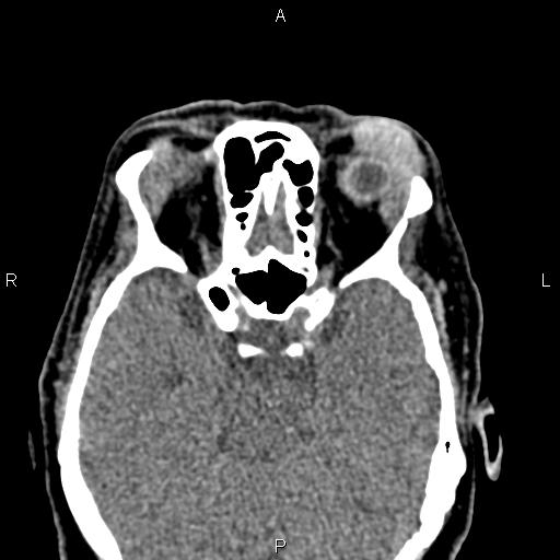 Bilateral enlargement of lacrimal glands - sarcoidosis (Radiopaedia 62627-70921 Axial non-contrast 54).jpg