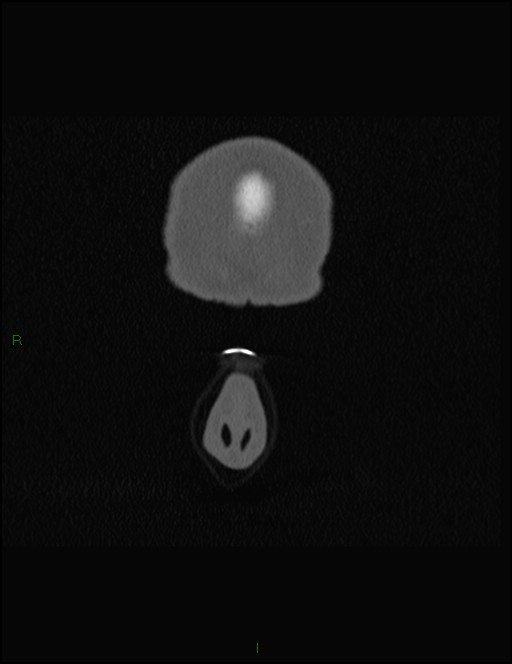 Bilateral frontal mucoceles (Radiopaedia 82352-96454 Coronal 17).jpg