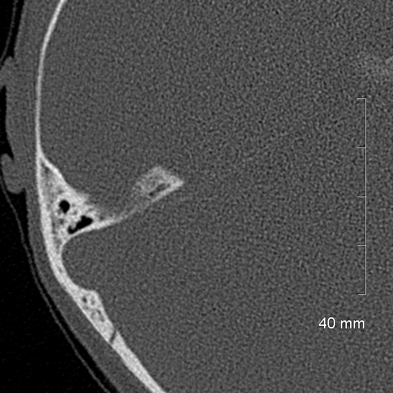 Bilateral grommets (Radiopaedia 47710-52404 Axial bone window 63).jpg