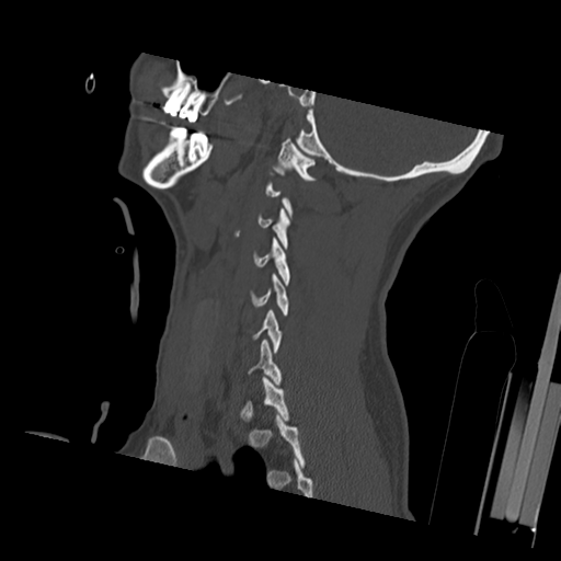 Bilateral locked facets (Radiopaedia 33850-35023 Sagittal bone window 16).png