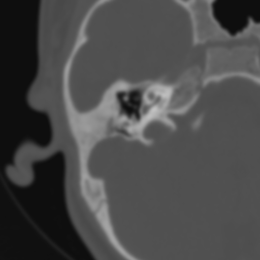 Bilateral otosclerosis (Radiopaedia 57237-64157 B 54).jpg