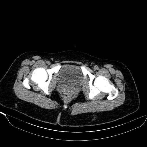 File:Bilateral ovarian dermoid (Radiopaedia 45714-49907 Axial non-contrast 43).JPEG