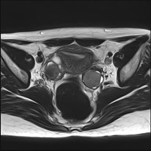 File:Bilateral ovarian endometriomas (Radiopaedia 87085-103347 Axial T2 10).jpg
