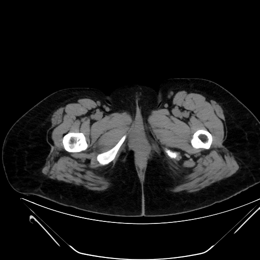 File:Bilateral ovarian mature cystic teratomas (Radiopaedia 79373-92457 Axial non-contrast 106).jpg