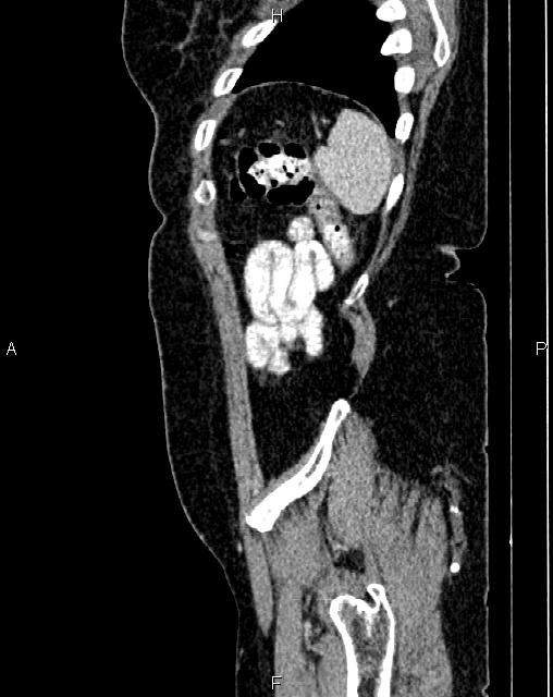 Bilateral ovarian serous cystadenocarcinoma (Radiopaedia 86062-101989 E 78).jpg