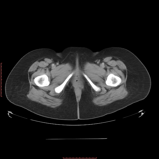 File:Bilateral ovarian serous cystadenocarcinoma with right ovarian torsion (Radiopaedia 32640-33611 A 46).jpg