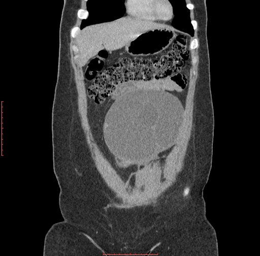 File:Bilateral ovarian serous cystadenocarcinoma with right ovarian torsion (Radiopaedia 32640-33611 B 6).jpg