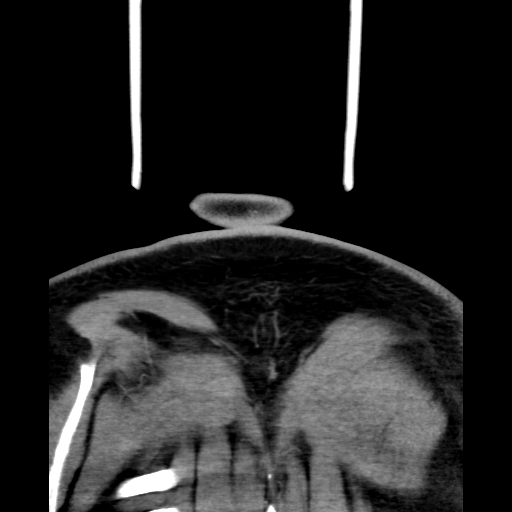 Bilateral peritonsillar abscess (Radiopaedia 85065-100610 Coronal 75).jpg