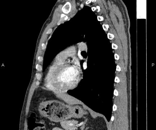 Bilateral pulmonary AVM (Radiopaedia 83134-97505 D 72).jpg