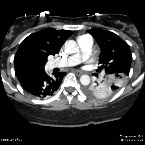 Bilateral pulmonary emboli with Hampton hump sign (Radiopaedia 54070-60246 Axial C+ CTPA 34).jpg