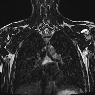 Bilateral spinoglenoid notch ganglion cysts (Radiopaedia 29577-30082 Coronal T2 79).jpg