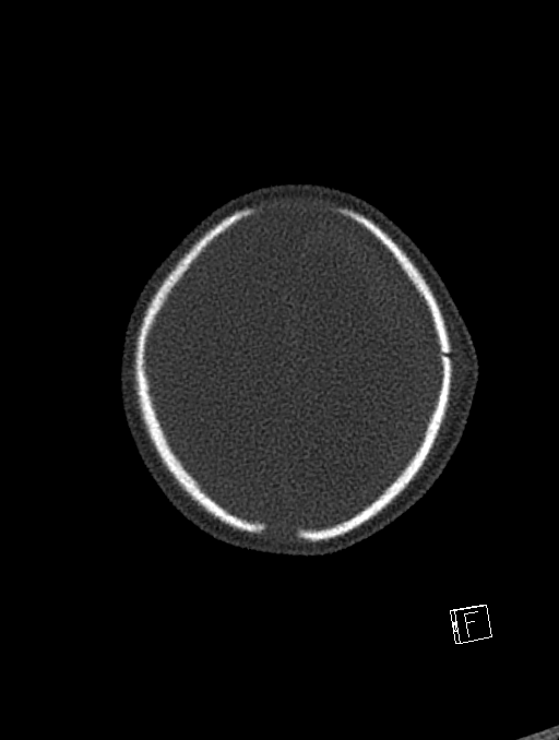 Bilateral subdural hemorrhage and parietal skull fracture (Radiopaedia 26058-26192 Axial bone window 15).png