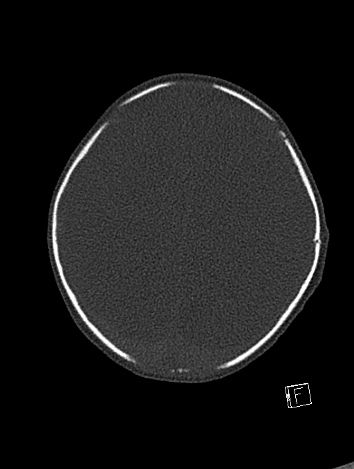 Bilateral subdural hemorrhage and parietal skull fracture (Radiopaedia 26058-26192 Axial bone window 31).png