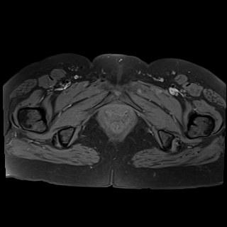 Bilateral tubo-ovarian abscesses (Radiopaedia 58635-65829 Axial T1 fat sat 44).jpg