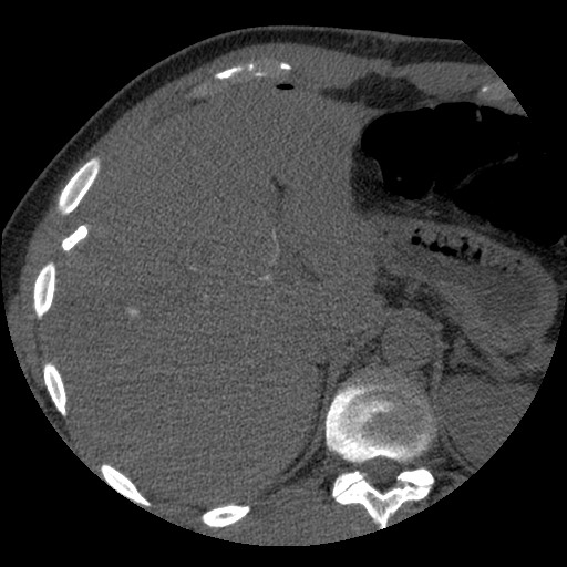 File:Bile leak from liver traumatic laceration (Radiopaedia 63463-72077 Axial Biliscopin 29).jpg