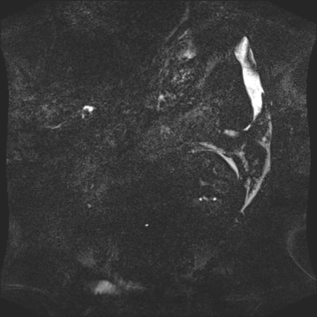 Biliary pancreatitis (Radiopaedia 72289-82824 Coronal 3D T2 89).jpg