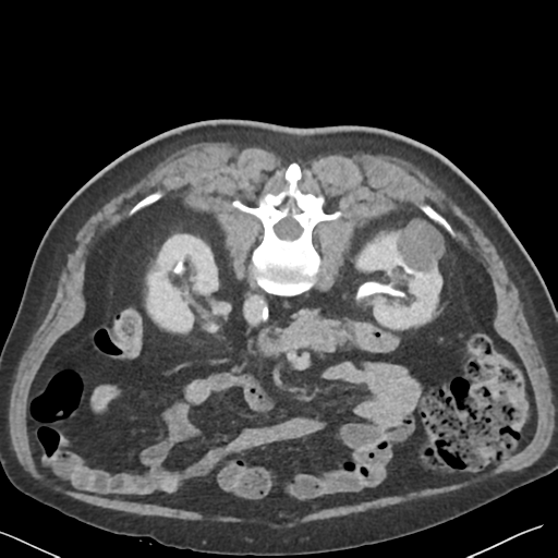 File:Bladder papillary urothelial carcinoma (Radiopaedia 48119-52951 Axial C+ delayed 20).png