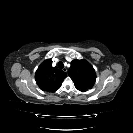 File:Bladder tumor detected on trauma CT (Radiopaedia 51809-57609 A 23).jpg
