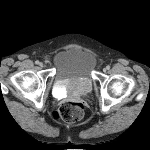 Bladder tumor detected on trauma CT (Radiopaedia 51809-57609 C 134).jpg