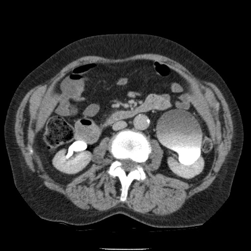 Bladder tumor detected on trauma CT (Radiopaedia 51809-57609 C 64).jpg