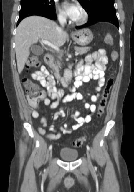 Bleeding duodenal ulcer and adenomyomatosis of gallbladder (Radiopaedia 61834-69861 B 48).jpg