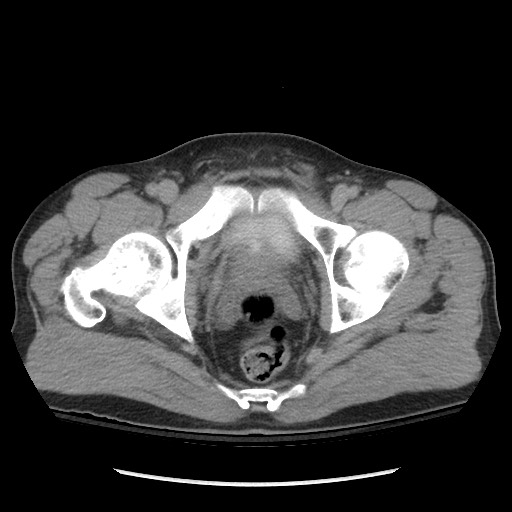 Blunt abdominal trauma with solid organ and musculoskelatal injury with active extravasation (Radiopaedia 68364-77895 Axial C+ delayed 131).jpg