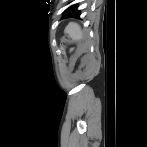 File:Blunt abdominal trauma with solid organ and musculoskelatal injury with active extravasation (Radiopaedia 68364-77895 C 127).jpg