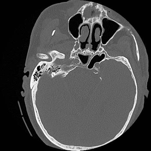File:Blunt cerebrovascular injury (Radiopaedia 53682-59743 Axial bone window 3).png