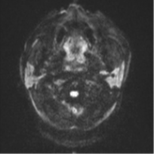 Blunt cerebrovascular injury (Radiopaedia 53682-59745 Axial DWI 31).png