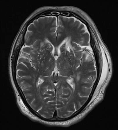 File:Blunt cerebrovascular injury (Radiopaedia 53682-59745 Axial T2 16).png