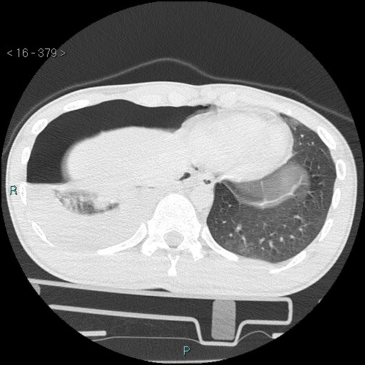 Blunt chest trauma (Swiss cheese sign) (Radiopaedia 38519-40618 Axial lung window 66).jpg
