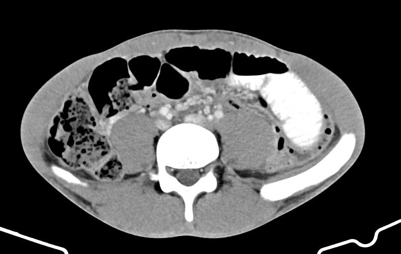 Blunt injury to the small bowel (Radiopaedia 74953-85987 A 120).jpg