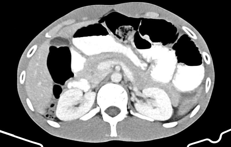 Blunt injury to the small bowel (Radiopaedia 74953-85987 A 47).jpg