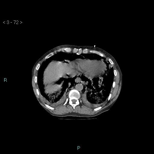 Boerhaave syndrome (Radiopaedia 27683-27897 Axial non-contrast 72).jpg