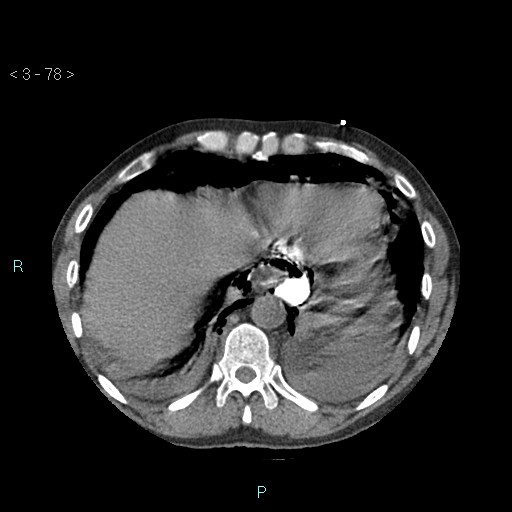 Boerhaave syndrome (Radiopaedia 27683-27897 oral contrast 78).jpg