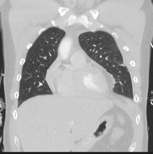 Boerhaave syndrome (Radiopaedia 39382-41661 Coronal lung window 15).png