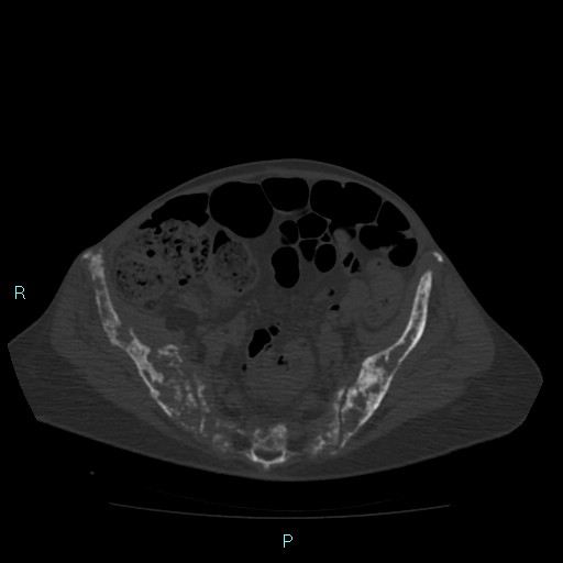File:Bone metastases from untreated breast cancer (Radiopaedia 42973-46219 Axial bone window 158).jpg