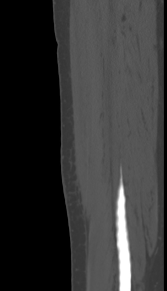 Bone metastasis - tibia (Radiopaedia 57665-64609 Sagittal bone window 142).jpg
