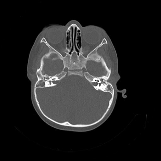 File:Bony atresia of the right external auditory canal (Radiopaedia 27916-28156 Axial bone window 7).jpg