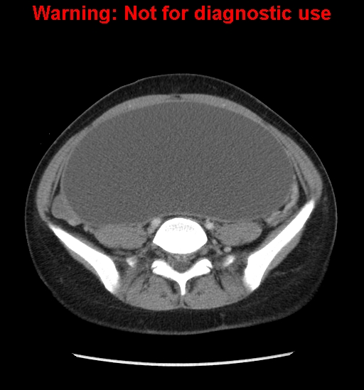 Borderline mucinous cystadenoma of ovary (Radiopaedia 25586-25767 A 62).jpg
