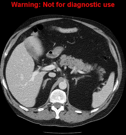 File:Bosniak renal cyst - type IV (Radiopaedia 23402-23466 D 19).jpg