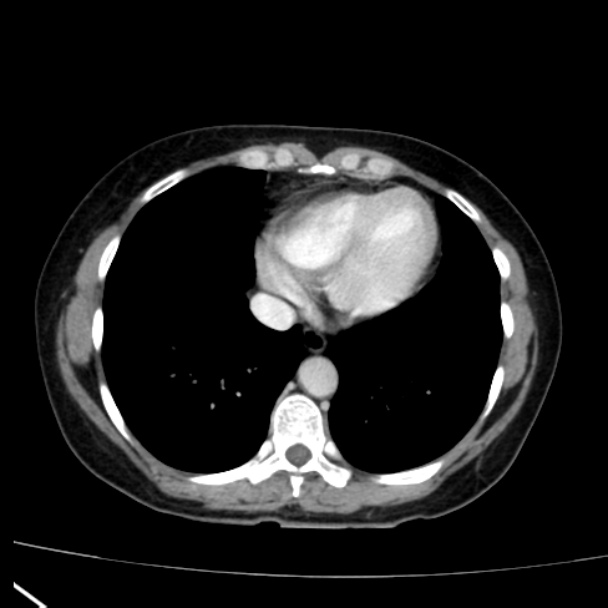 Bosniak renal cyst - type I (Radiopaedia 27479-27675 C 2).jpg