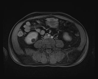 File:Bouveret syndrome (Radiopaedia 61017-68856 Axial T1 C+ fat sat 61).jpg