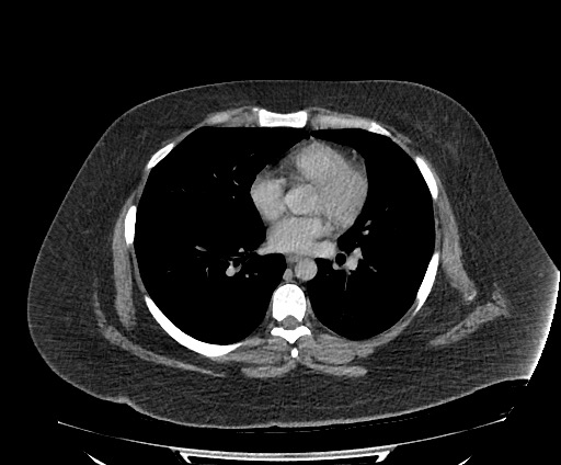 Bowel and splenic infarcts in acute lymphocytic leukemia (Radiopaedia 61055-68913 A 4).jpg