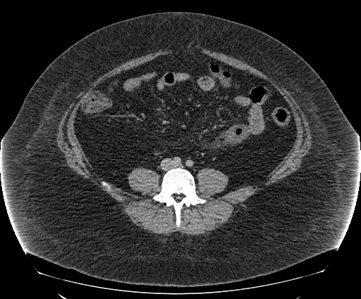 File:Bowel and splenic infarcts in acute lymphocytic leukemia (Radiopaedia 61055-68913 A 81).jpg