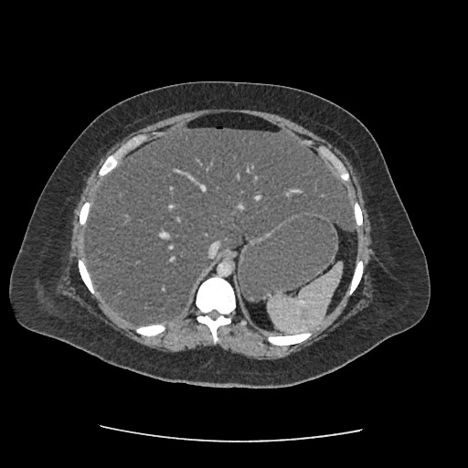 Bowel and splenic infarcts in acute lymphocytic leukemia (Radiopaedia 61055-68915 A 35).jpg